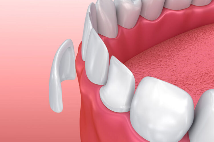 Modelo de carilla dental de porcelana en boca, mostrando dientes frontales y encías, ilustrando tratamientos estéticos ofrecidos por La Clínica Dental Guadalajara.