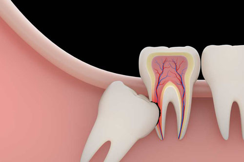 Ilustración de dientes mostrando la anatomía dental con enfoque en la raíz, relevante para tratamientos de endodoncia en La Clínica Dental Guadalajara.
