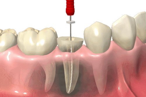 Procedimiento de endodoncia mostrando un diente con tratamiento, herramienta dental en acción, ilustración de la clínica dental.