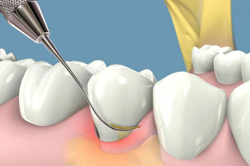 Ilustración de tratamiento periodontal mostrando un instrumento dental limpiando la superficie de un diente, destacando la encía inflamada en La Clínica Dental Guadalajara.