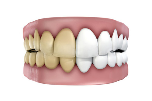 Modelo de dientes mostrando el antes y después del blanqueamiento dental, destacando la diferencia de tonalidad entre dientes amarillos y blancos.