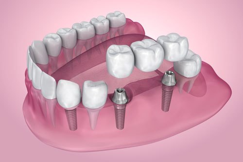 Modelo de implantes dentales con dientes artificiales sobre base rosa, representando tratamientos de implantología en La Clínica Dental Guadalajara.