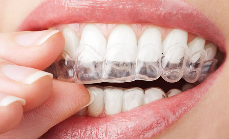 Persona colocando alineador transparente en dientes, destacando ortodoncia invisible para alineación dental.