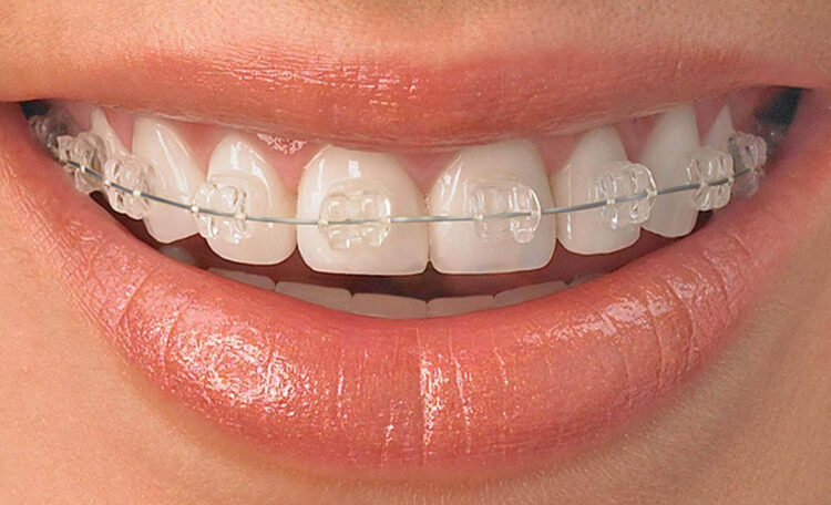 Sonrisa con brackets de ortodoncia transparente, mostrando dientes alineados y cuidado dental estético.