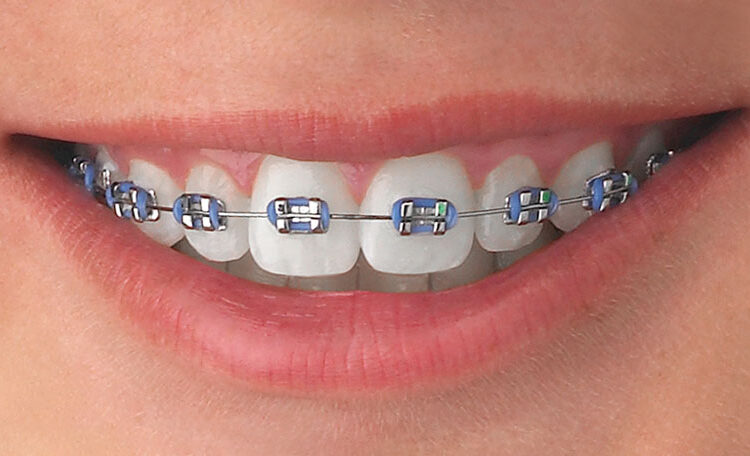 Sonrisa de persona con brackets metálicos, destacando la alineación dental y el uso de ligaduras de color azul, representando un tratamiento de ortodoncia.