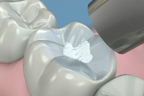 Resina de alta est&eacute;tica