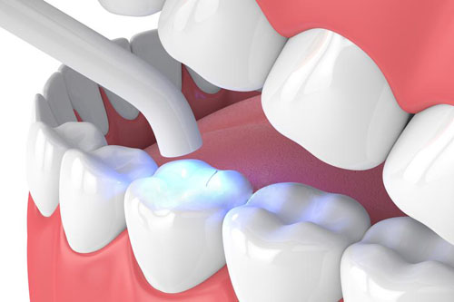 Aplicación de resina dental estética en dientes, mostrando procedimiento de restauración dental en clínica.