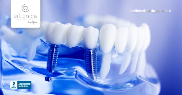 Modelo de dientes con implantes dentales, resaltando la tecnología avanzada en odontología de La Clínica Dental Guadalajara.