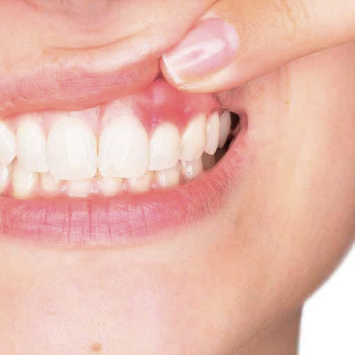 Irritación de encías por blanqueamiento dental, mostrando dientes blancos y encías expuestas.