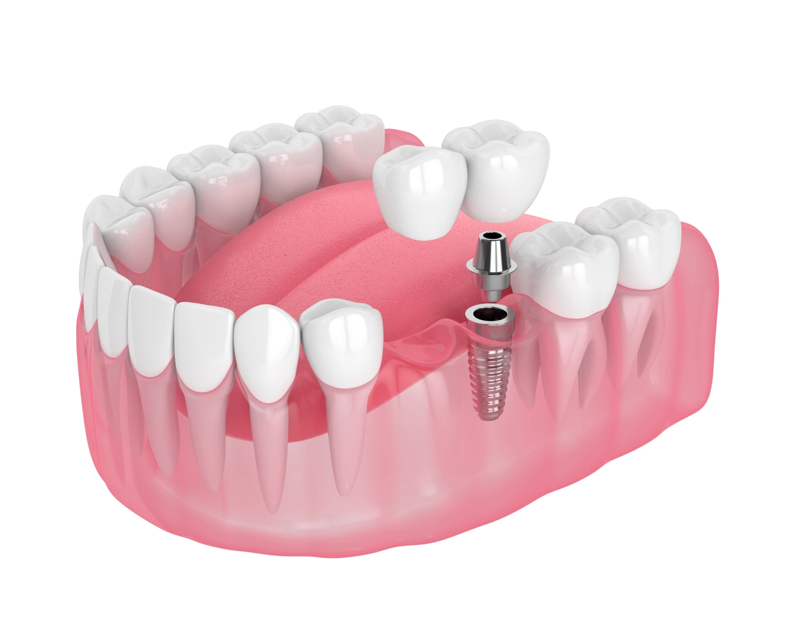 implant