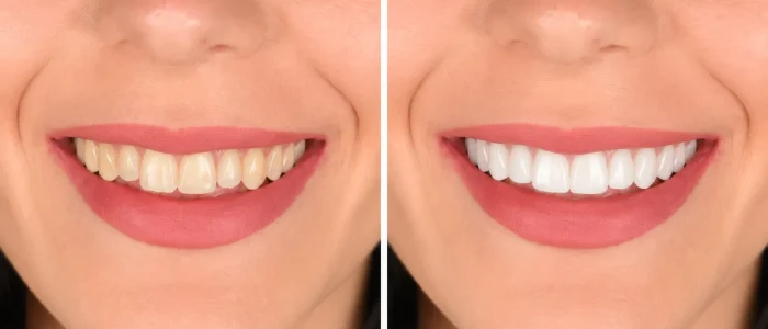 antes despues carillas dentales caso 1
