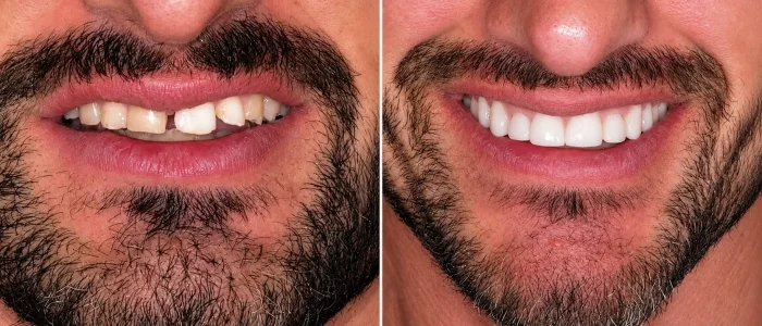 antes despues carillas dentales caso 2